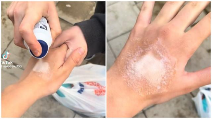 Nou pericol pe TikTok. Adolescenți mutilați pe viață după ce au răspuns la provocarea deodorantului