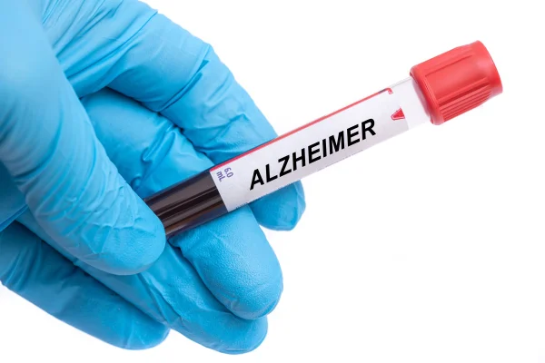 Hong Kongul foloseşte inteligenţa artificială pentru a prezice riscul de Alzheimer prin analiza imagistică a retinei