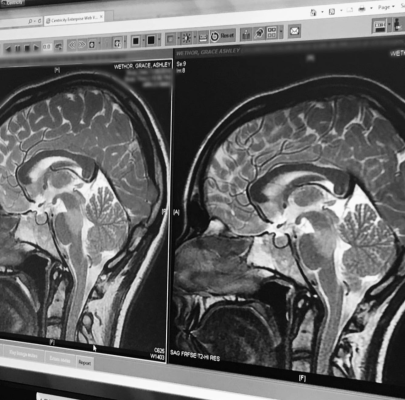 Un nou tip de RMN mai puternic. Cercetătorii speră să înţeleagă mai bine tulburările de neurodezvoltare şi bolile cerebrale la copii