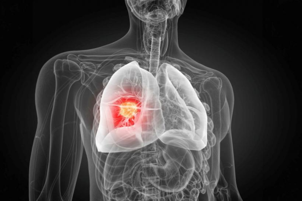 Poluarea aerului, asociată cu mutațiile ADN generatoare de cancer pulmonar