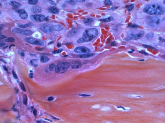 Cât timp poți trăi cu cancer de prostată în stadiu avansat? Povestea bărbatului care schiază și navighează după 14 ani de la diagnostic