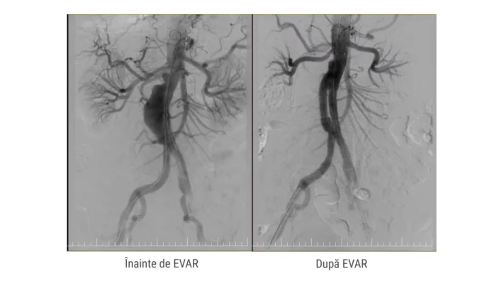 Anevrismul de aortă toraco-abdominal: Simptomele apar când afecțiunea este deja gravă. Cum se tratează microinvaziv și chirurgical la MONZA ARES